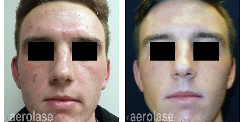 NeoSkin Rejuvenation After 3 Treatments Kevin Pinski MD