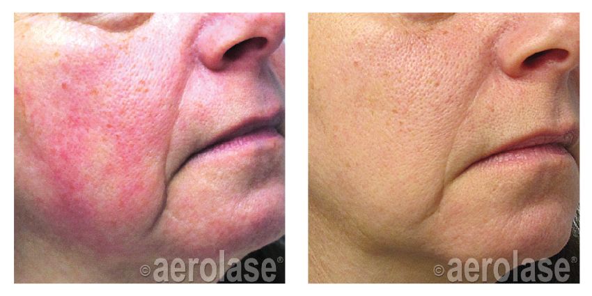 NeoSkin Rosacea After 1 Treatment Yelena Kipervas DO