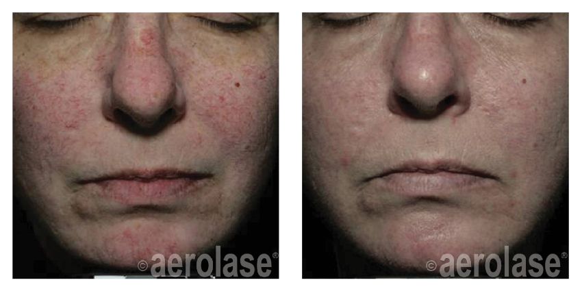 NeoSkin Rosacea and Veins After 2 Treatments David Goldberg MD