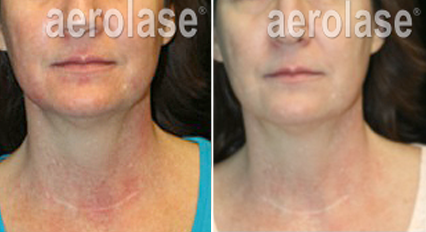 Rosacea3 Pair