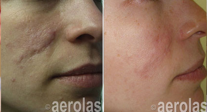 Scar Revision2 Pair