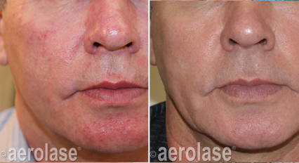 Skin Rejuvenation7 Pair