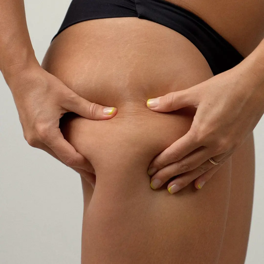 Cellulite Reduction