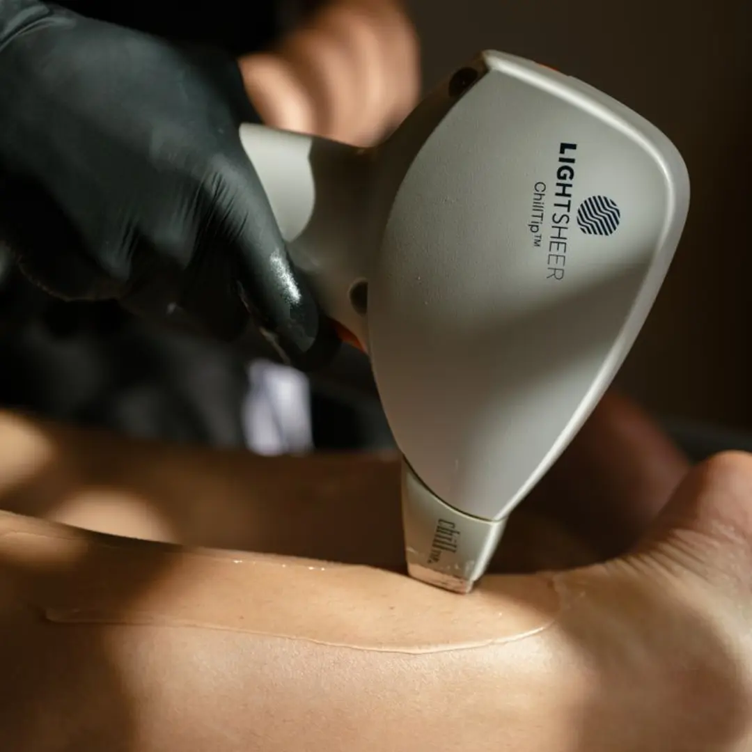 Laser Hair Removal